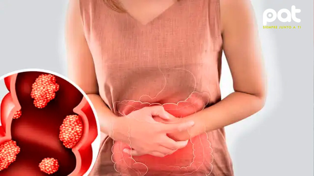 http://www.redpat.tv//uploads/Cancer_de_colon_en_adultos_jovenes_70ff11559b.jpg