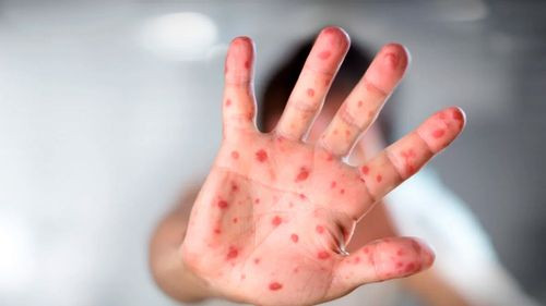 Niños sin carnet de vacunación contra el sarampión no podrán viajar desde Santa Cruz