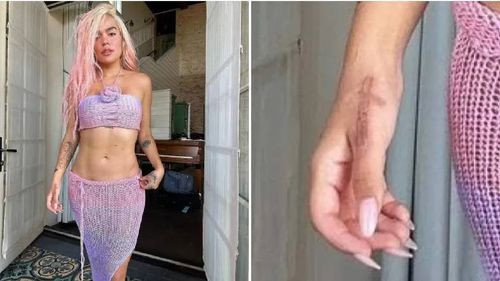 Karol G se borró el tatuaje de Anuel AA y así luce ahora