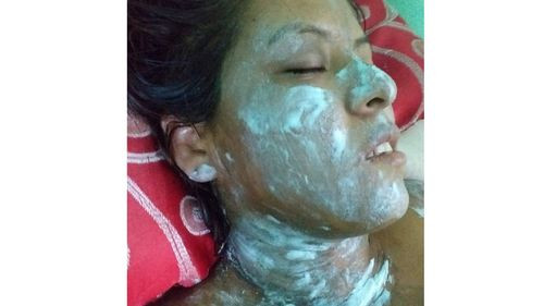 Ataque con ácido deja a Joven de 21 Años en estado crítico; vecina acusada