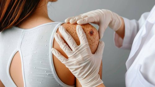Cáncer de piel, una enfermedad silenciosa que podemos prevenir