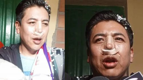 Pumari habla de la lesión que sufrió en la nariz y denuncia que no le permitieron asistir a segunda cirugía