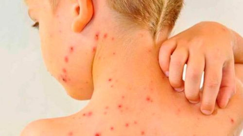 Gobierno declara emergencia sanitaria nacional por epidemia de sarampión