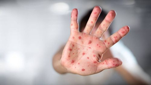 Prevención del Sarampión: Estrategias Clave para Evitar un Nuevo Brote