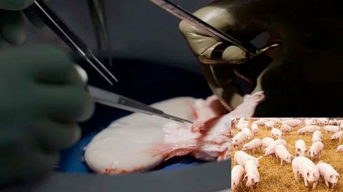 Histórico trasplante de riñón de cerdo a paciente con muerte cerebral abre nuevas posibilidades