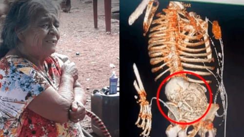 Mujer muere tras cirugía para retirar un feto calcificado que tuvo por más de 30 años