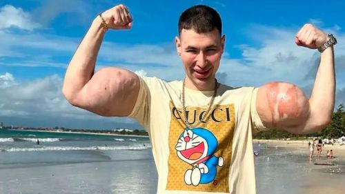 La obsesión por bíceps gigantes deja al “Popeye ruso” al borde de perder sus brazos