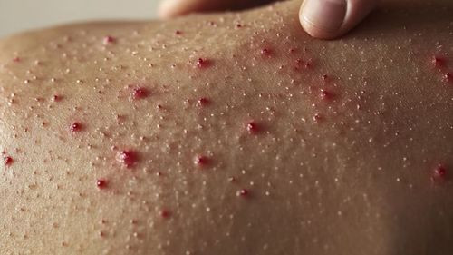 Santa Cruz confirma cuatro nuevos casos de sarampión y mantiene alerta roja sanitaria