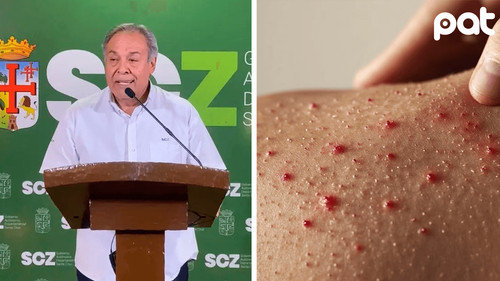 Santa Cruz en alerta roja por sarampión