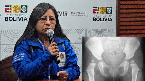Campaña gratuita detecta displasia de cadera en bebés en La Paz