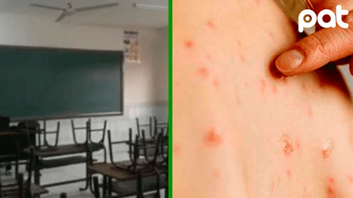 Primer caso de sarampión en Cochabamba obliga a suspender clases presenciales