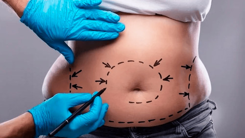 Aparecen nuevas víctimas de la odontóloga que realizó liposucciones
