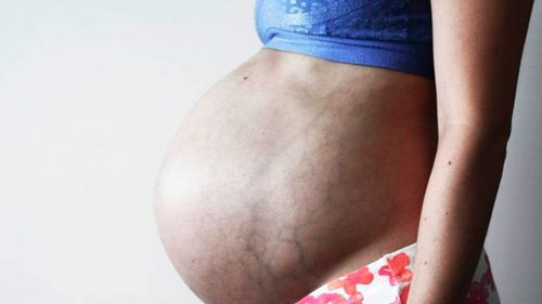    Una madre buscaba que le practiquen una cesárea, pero le entregaron a su bebé quemada, denuncia la familia
